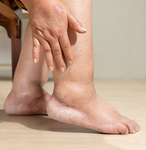 Limb swelling